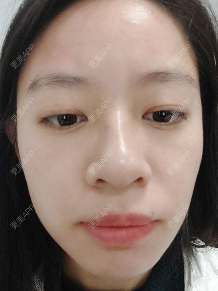 更美 - 更美用户FKgNeqD2Py的黑脸娃娃经验 | 光子嫩肤 | 白瓷娃娃 | 黑脸娃娃 | 彩光嫩肤 | 美白导入 | 点阵激光 | 注射美白 | 镭射净肤 | 果酸焕肤 | 激光淡斑 | 美白套餐 | 重庆