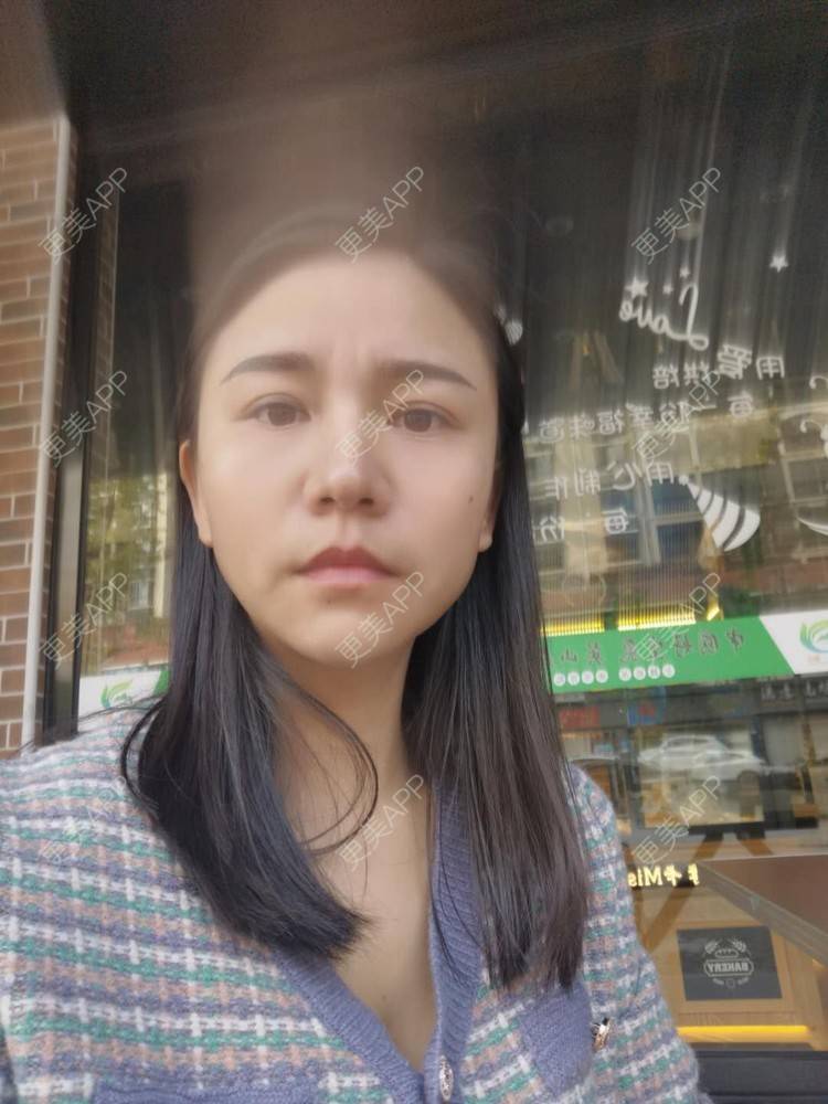 更美 - 更美用户oO6cwBT0l6的额头经验 | 硅胶丰太阳穴 | 太阳穴 | 膨体丰太阳穴 | 额头 | 硅胶丰额头 | 自体脂肪丰太阳穴 | 玻尿酸太阳穴 | 小切口手术提升