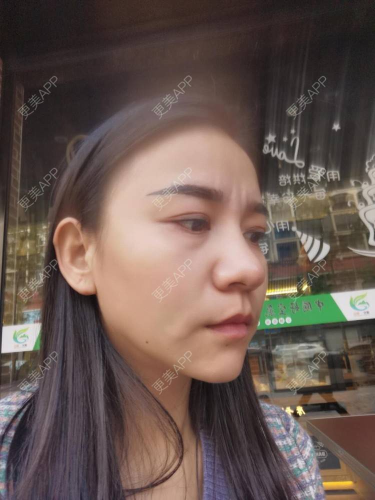 更美 - 更美用户oO6cwBT0l6的额头经验 | 硅胶丰太阳穴 | 太阳穴 | 膨体丰太阳穴 | 额头 | 硅胶丰额头 | 自体脂肪丰太阳穴 | 玻尿酸太阳穴 | 小切口手术提升