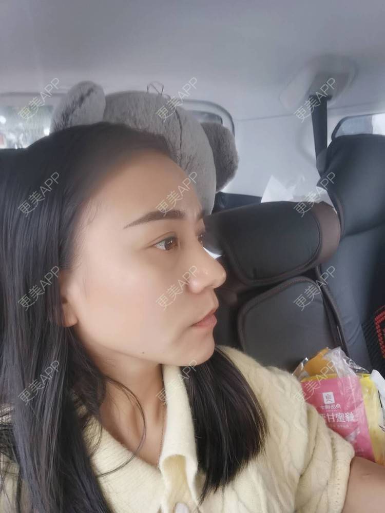 更美 - 更美用户oO6cwBT0l6的额头经验 | 硅胶丰太阳穴 | 太阳穴 | 硅胶丰额头 | 额头 | 轮廓套餐 | 自体脂肪丰太阳穴 | 玻尿酸太阳穴 | 膨体丰太阳穴 | 小切口手术提升