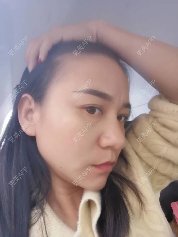更美 - 更美用户oO6cwBT0l6的额头经验 | 硅胶丰太阳穴 | 太阳穴 | 硅胶丰额头 | 额头 | 轮廓套餐 | 自体脂肪丰太阳穴 | 玻尿酸太阳穴 | 膨体丰太阳穴 | 小切口手术提升