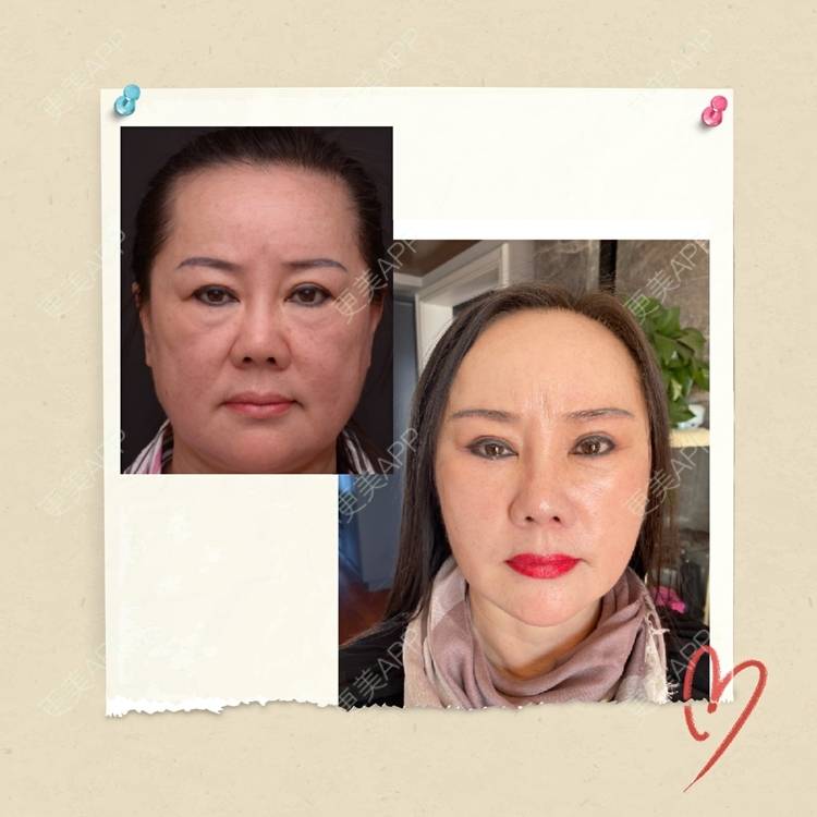 更美 - 小学生会长的祛皱经验 | 小切口手术提升 | 祛皱 | SMAS除皱手术 | 北京