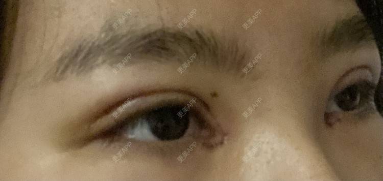 更美 - 更美用户LlGf9K7w9y的眼部多项经验 | 青岛 | 眼部多项