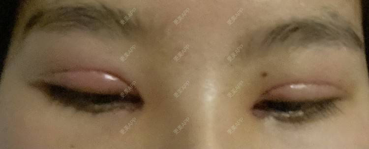 更美 - 更美用户LlGf9K7w9y的眼部多项经验 | 青岛 | 眼部多项