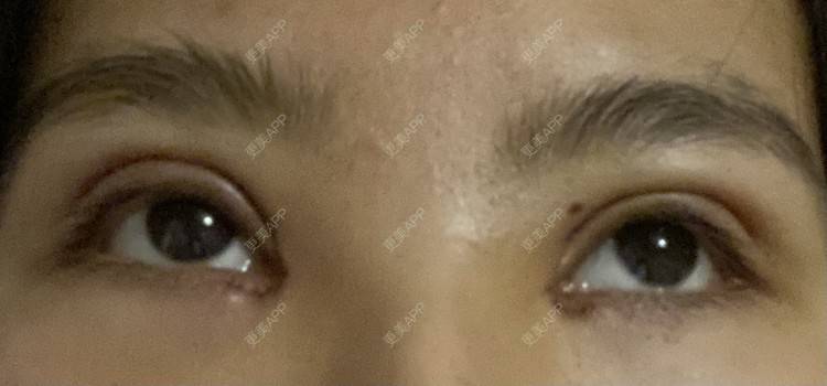 更美 - 更美用户LlGf9K7w9y的眼部多项经验 | 青岛 | 眼部多项