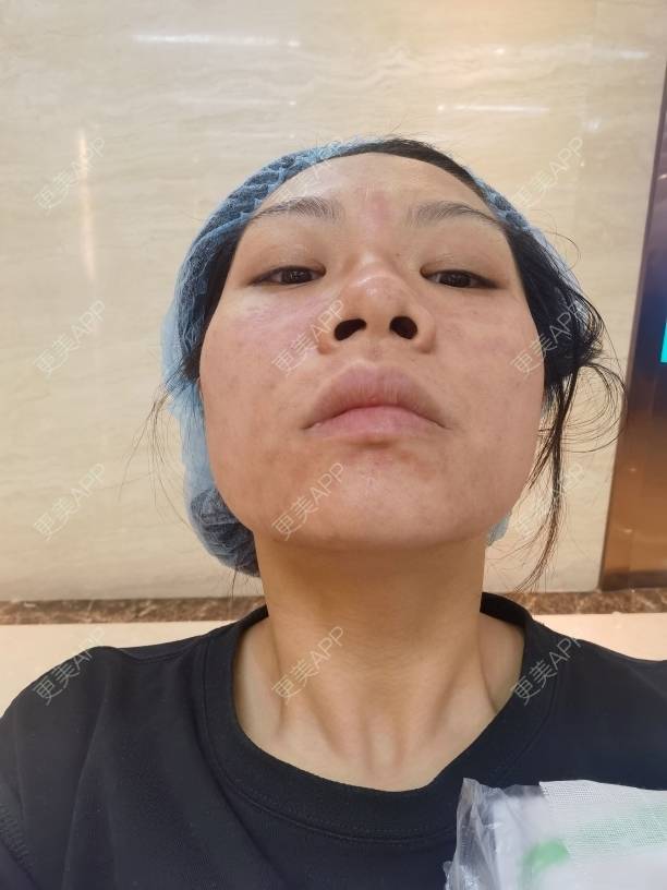 更美 - 油腻叉烧包的皮秒激光经验 | 广州 | 皮秒激光