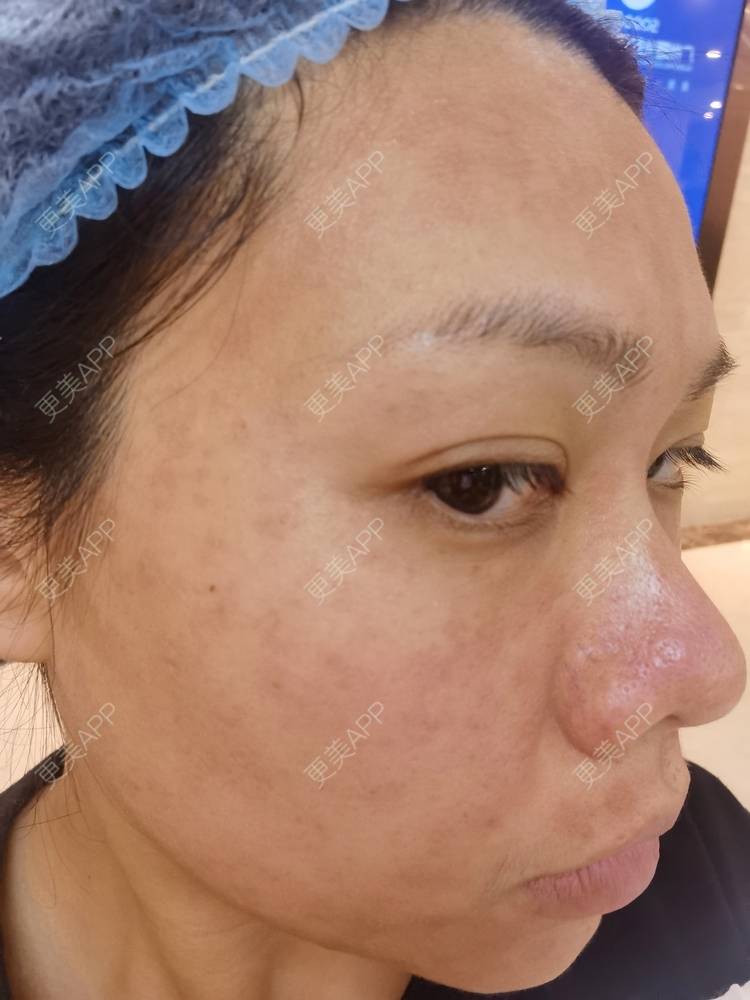 更美 - 油腻叉烧包的皮秒激光经验 | 广州 | 皮秒激光