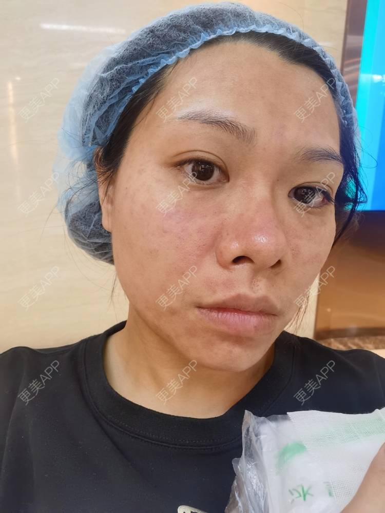 更美 - 油腻叉烧包的皮秒激光经验 | 广州 | 皮秒激光
