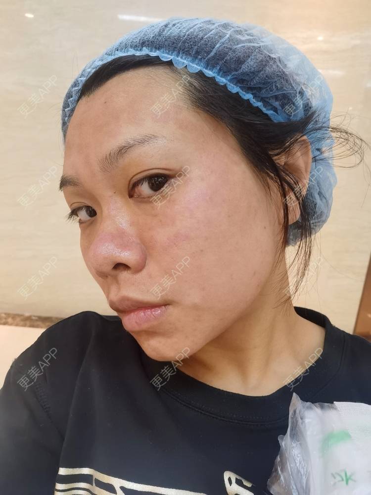 更美 - 油腻叉烧包的皮秒激光经验 | 广州 | 皮秒激光