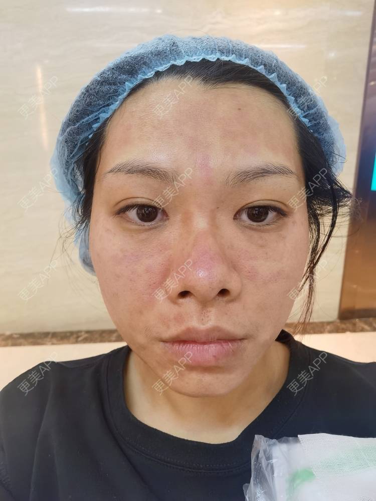 更美 - 油腻叉烧包的皮秒激光经验 | 广州 | 皮秒激光