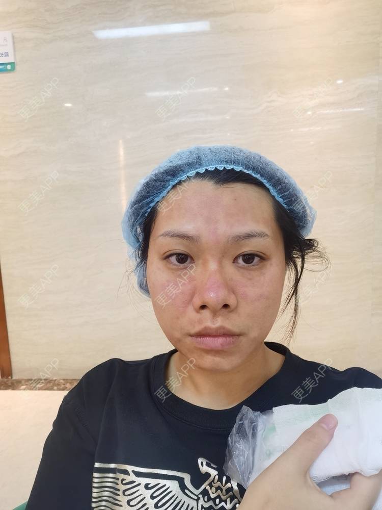 更美 - 油腻叉烧包的皮秒激光经验 | 广州 | 皮秒激光