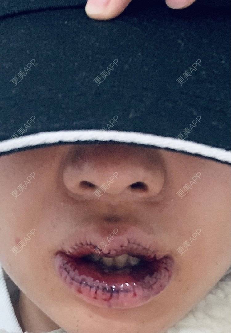 人生路命运的厚唇改薄术日记