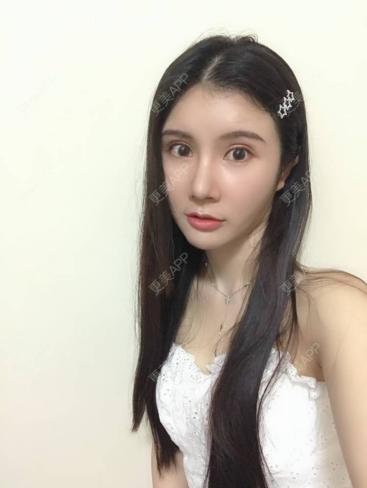 更美 - 圆圆园小姐姐的PRP自体血清美肤经验 | PRP自体血清美肤 | 广州 | 视频日记