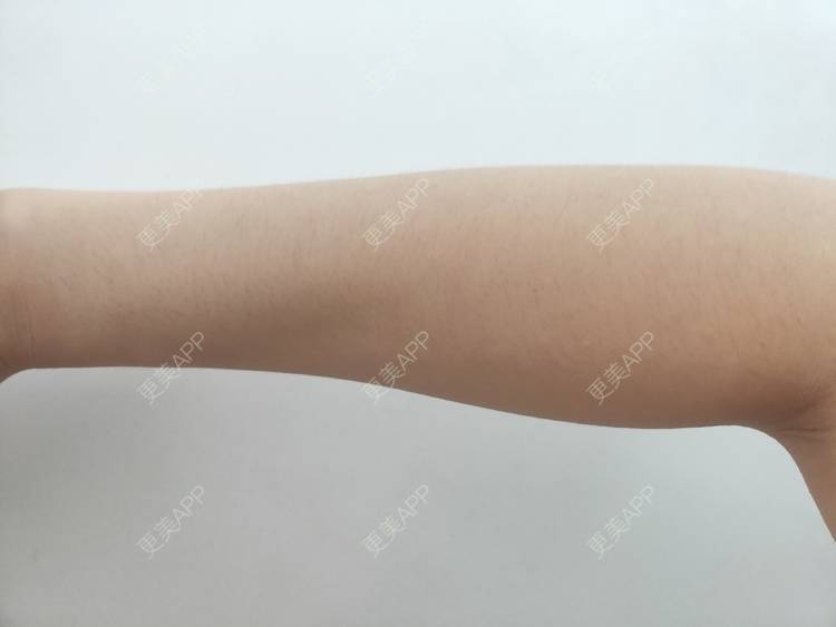 更美 - 更美用户ULBdsFURSw的手臂脱毛经验 | 广州 | 视频日记 | 手臂脱毛