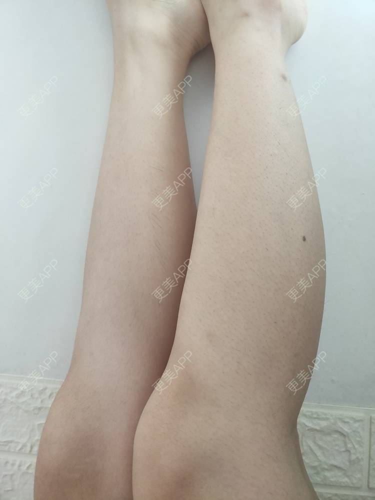 更美 - 更美用户ULBdsFURSw的手臂脱毛经验 | 广州 | 视频日记 | 手臂脱毛