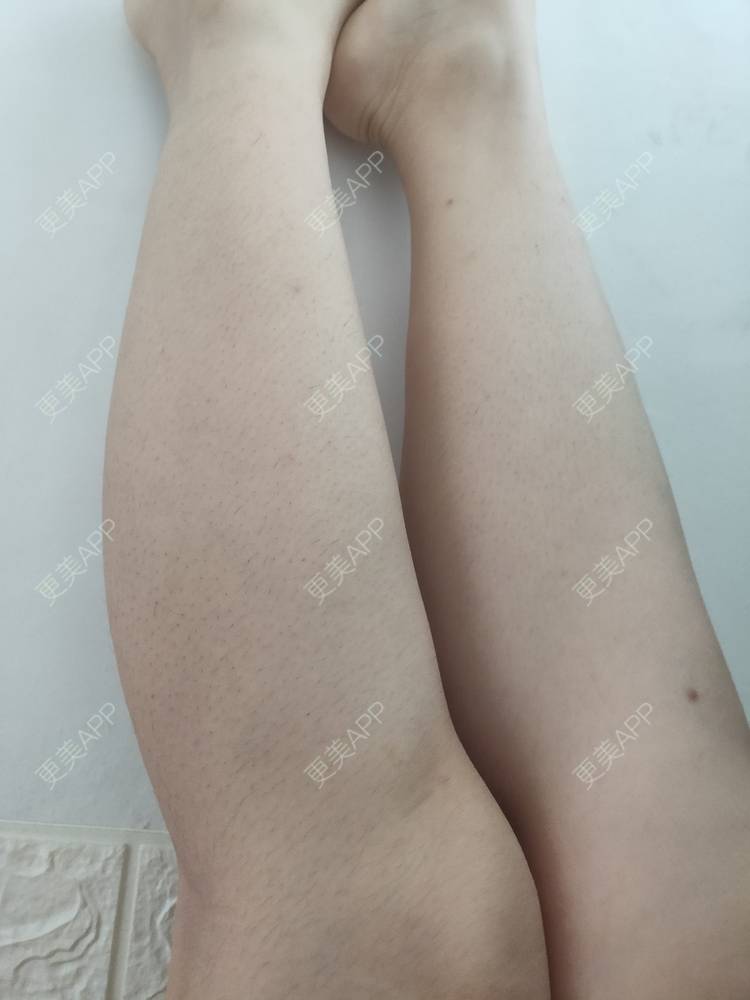 更美 - 更美用户ULBdsFURSw的手臂脱毛经验 | 广州 | 视频日记 | 手臂脱毛