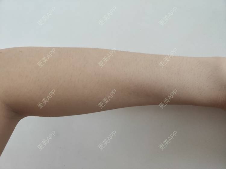 更美 - 更美用户ULBdsFURSw的手臂脱毛经验 | 广州 | 视频日记 | 手臂脱毛