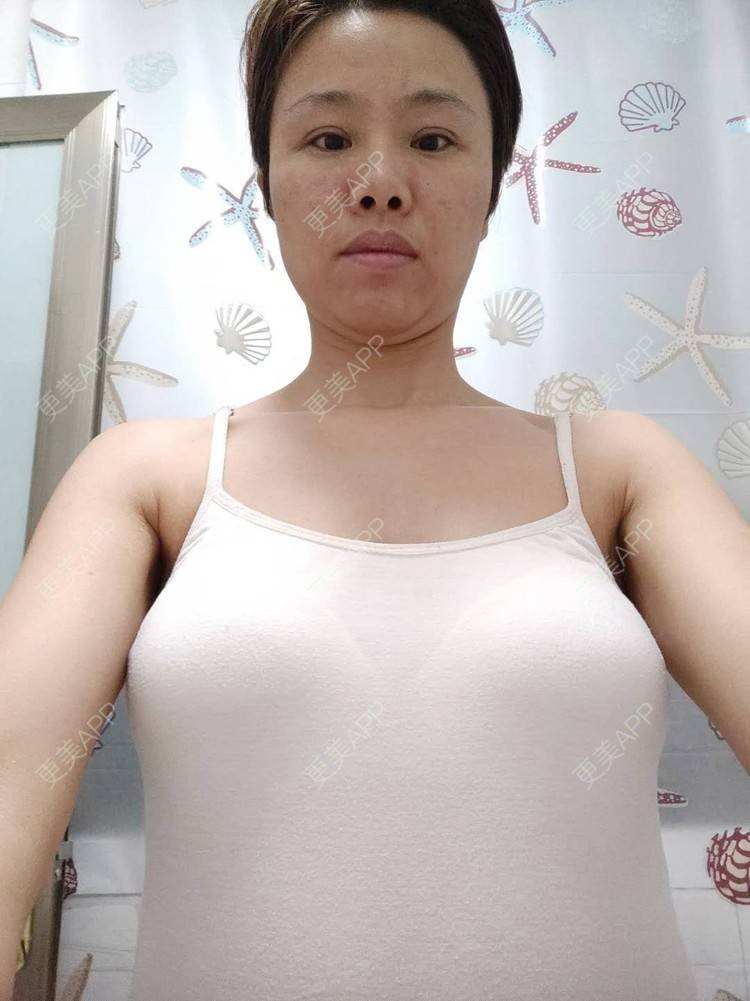 更美 - 更美用户gZFN64zuwo的丰胸（隆胸）经验 | 自体脂肪隆胸 | 胸部下垂矫正 | 乳房再造 | 美胸套餐 | 乳头内陷矫正 | 重庆 | 胶原蛋白丰胸 | 复合隆胸