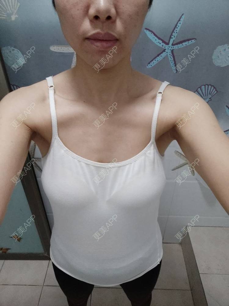 更美 - 更美用户gZFN64zuwo的丰胸（隆胸）经验 | 自体脂肪隆胸 | 胸部下垂矫正 | 乳房再造 | 美胸套餐 | 乳头内陷矫正 | 重庆 | 胶原蛋白丰胸 | 复合隆胸