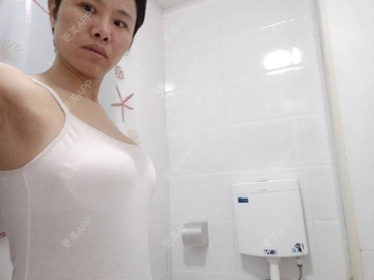 更美 - 更美用户gZFN64zuwo的丰胸（隆胸）经验 | 自体脂肪隆胸 | 胸部下垂矫正 | 乳房再造 | 美胸套餐 | 乳头内陷矫正 | 重庆 | 胶原蛋白丰胸 | 复合隆胸
