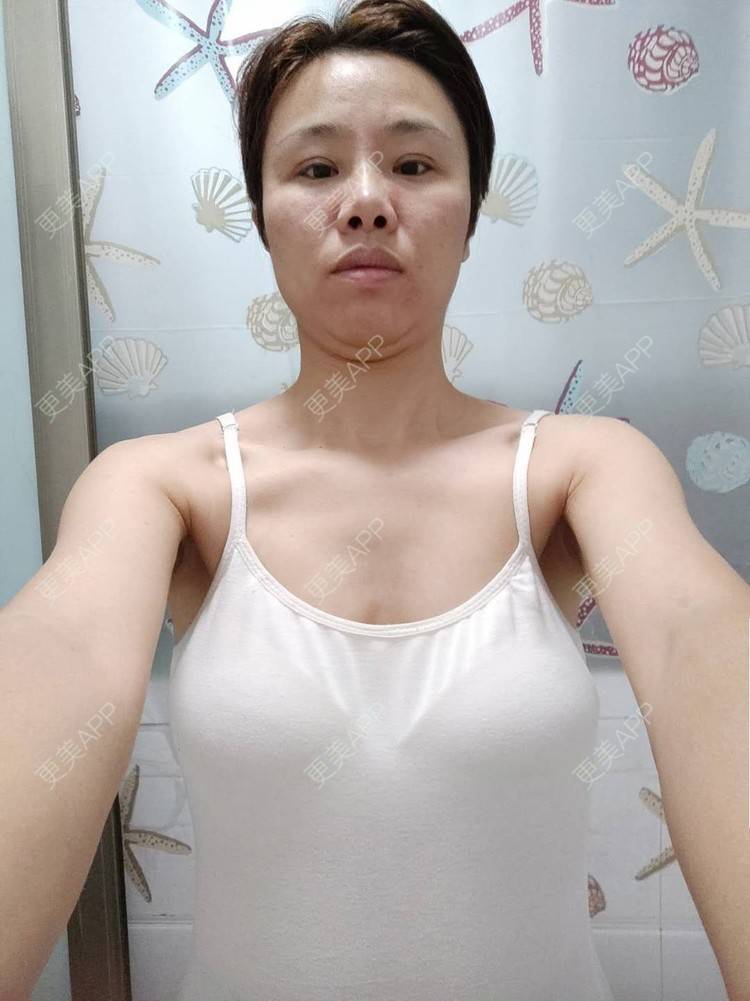 更美 - 更美用户gZFN64zuwo的丰胸（隆胸）经验 | 自体脂肪隆胸 | 胸部下垂矫正 | 乳房再造 | 美胸套餐 | 乳头内陷矫正 | 重庆 | 胶原蛋白丰胸 | 复合隆胸
