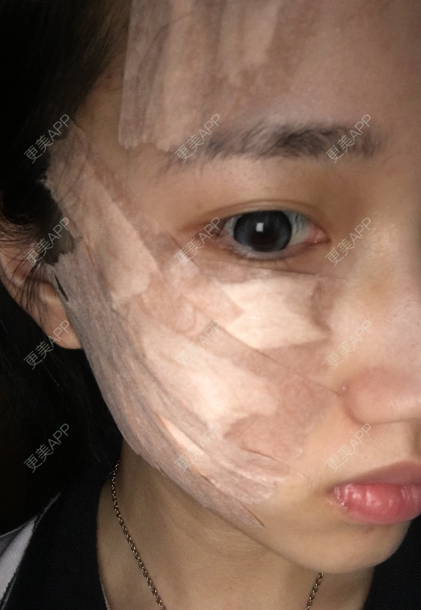 更美 - 灬爱笑のгeη哭ぅ肆的自体脂肪丰苹果肌经验 | 自体脂肪丰苹果肌 | 长沙