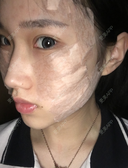 更美 - 灬爱笑のгeη哭ぅ肆的自体脂肪丰苹果肌经验 | 自体脂肪丰苹果肌 | 长沙