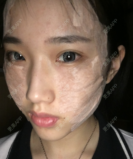 更美 - 灬爱笑のгeη哭ぅ肆的自体脂肪丰苹果肌经验 | 自体脂肪丰苹果肌 | 长沙