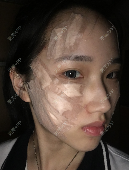 更美 - 灬爱笑のгeη哭ぅ肆的自体脂肪丰苹果肌经验 | 自体脂肪丰苹果肌 | 长沙