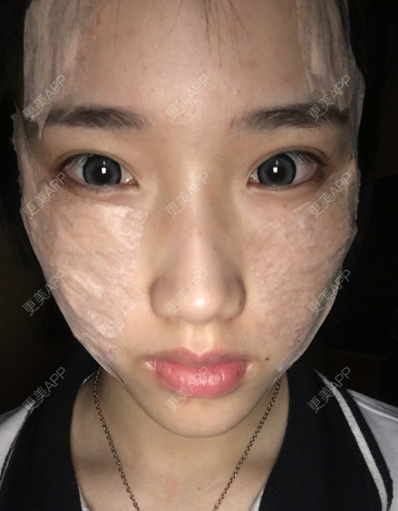 更美 - 灬爱笑のгeη哭ぅ肆的自体脂肪丰苹果肌经验 | 自体脂肪丰苹果肌 | 长沙