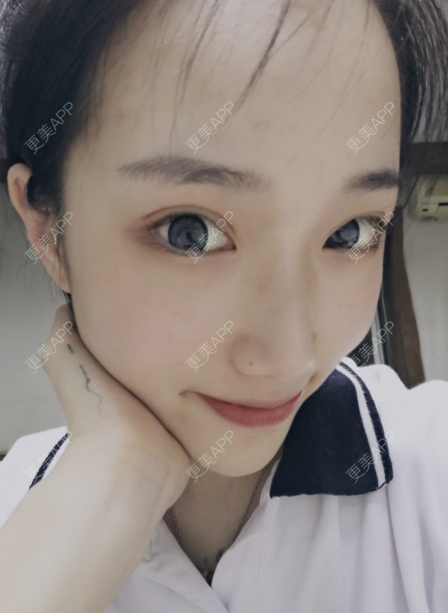 更美 - 灬爱笑のгeη哭ぅ肆的自体脂肪丰苹果肌经验 | 自体脂肪丰苹果肌 | 长沙