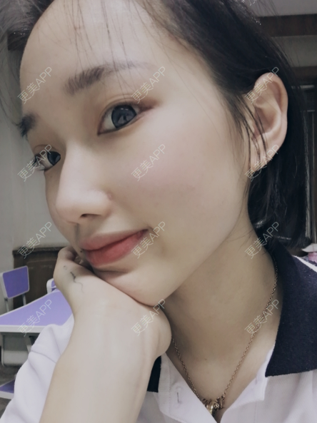 更美 - 灬爱笑のгeη哭ぅ肆的自体脂肪丰苹果肌经验 | 自体脂肪丰苹果肌 | 长沙