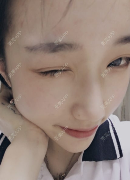 更美 - 灬爱笑のгeη哭ぅ肆的自体脂肪丰苹果肌经验 | 自体脂肪丰苹果肌 | 长沙