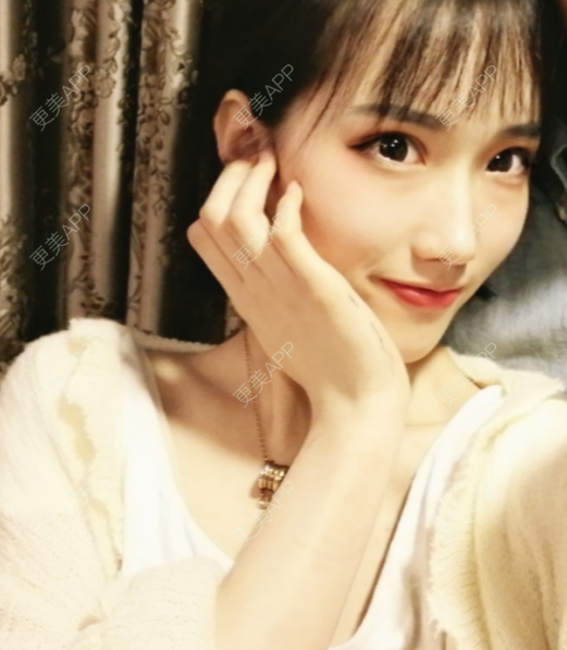 更美 - 灬爱笑のгeη哭ぅ肆的自体脂肪丰苹果肌经验 | 自体脂肪丰苹果肌 | 长沙