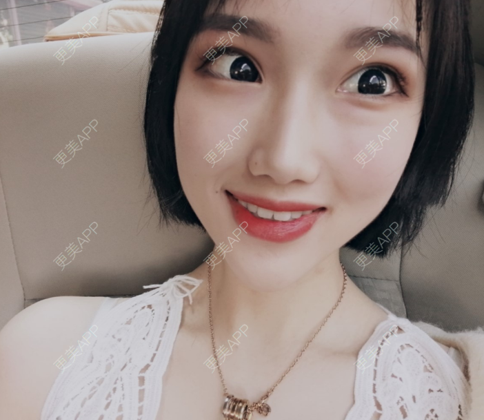 更美 - 灬爱笑のгeη哭ぅ肆的自体脂肪丰苹果肌经验 | 自体脂肪丰苹果肌 | 长沙