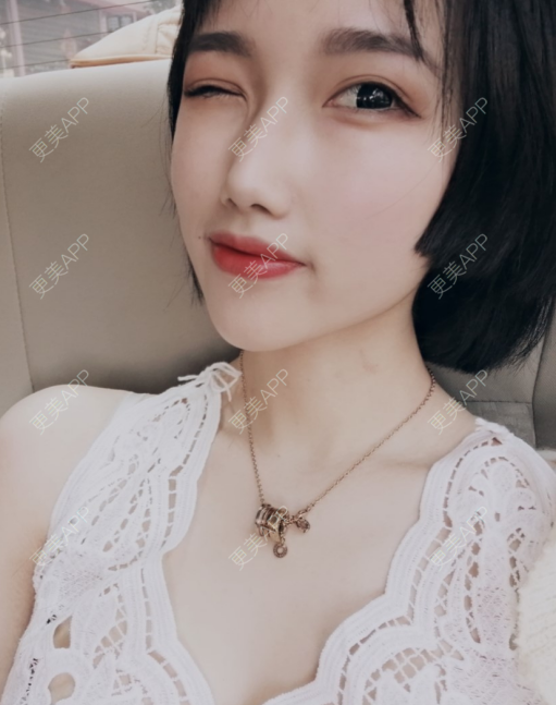 更美 - 灬爱笑のгeη哭ぅ肆的自体脂肪丰苹果肌经验 | 自体脂肪丰苹果肌 | 长沙