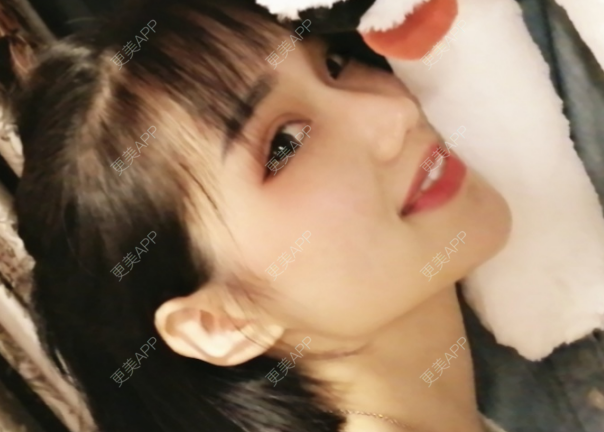 更美 - 灬爱笑のгeη哭ぅ肆的自体脂肪丰苹果肌经验 | 自体脂肪丰苹果肌 | 长沙