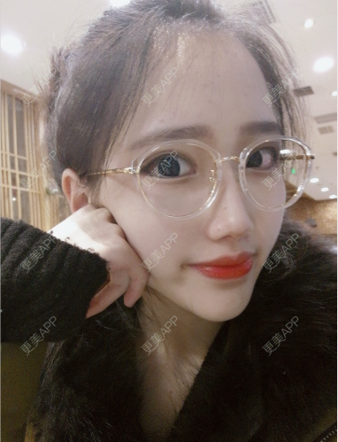 更美 - 灬爱笑のгeη哭ぅ肆的自体脂肪丰苹果肌经验 | 自体脂肪丰苹果肌 | 长沙