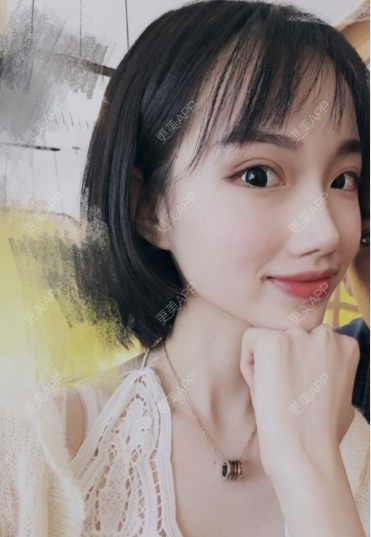 更美 - 灬爱笑のгeη哭ぅ肆的自体脂肪丰苹果肌经验 | 自体脂肪丰苹果肌 | 长沙