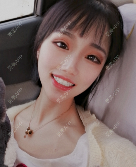 更美 - 灬爱笑のгeη哭ぅ肆的自体脂肪丰苹果肌经验 | 自体脂肪丰苹果肌 | 长沙