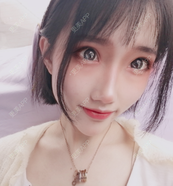 更美 - 灬爱笑のгeη哭ぅ肆的自体脂肪丰苹果肌经验 | 自体脂肪丰苹果肌 | 长沙