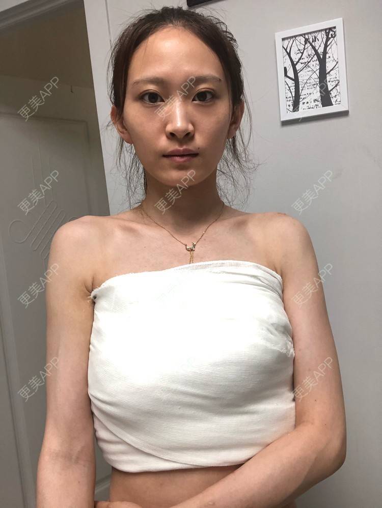 更美用户2uuuukwckl的假体隆胸分享_假体隆胸【图片 价格】__术后178