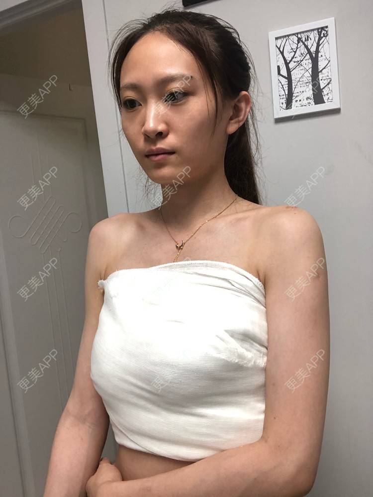 更美用户2uuuukwckl的假体隆胸分享_假体隆胸【图片 价格】__术后178