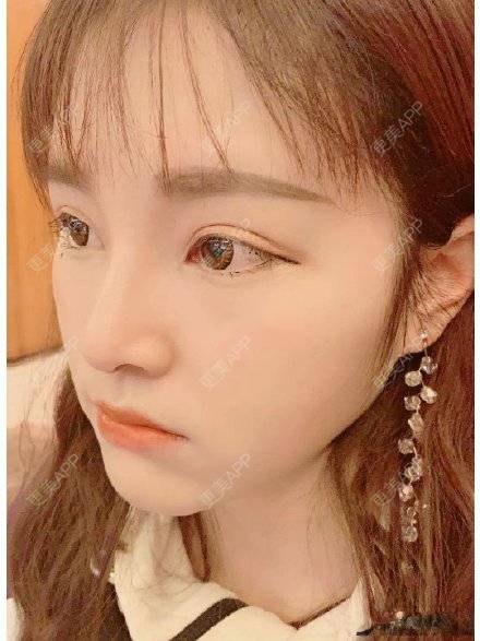 更美 - 尒の狂彧嘢‰兜的硅胶隆鼻经验 | 硅胶隆鼻 | 武汉