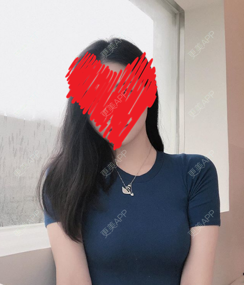 更美 - 更美用户yJ99QrEknW的自体脂肪填充颈纹经验 | 自体脂肪填充颈纹