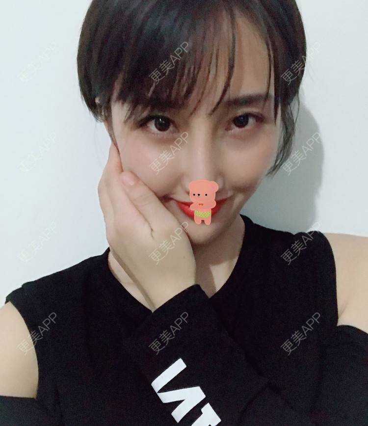 更美 - 更美用户1ieoNiY7aB的植发际线经验 | 北京 | 植发际线 | 毛发移植