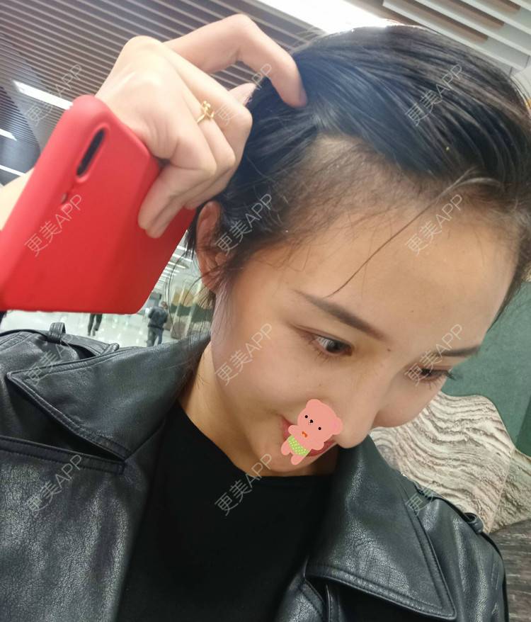 更美 - 更美用户1ieoNiY7aB的植发际线经验 | 北京 | 植发际线 | 毛发移植