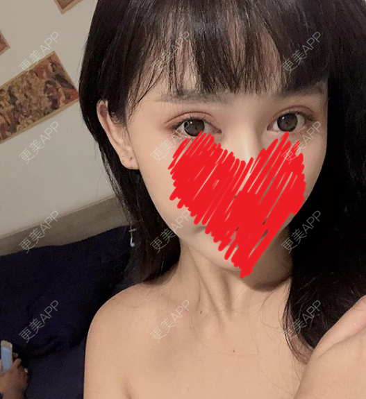 更美 - 更美用户XQLeLyMyaD的自体脂肪填充颈纹经验 | 自体脂肪填充颈纹