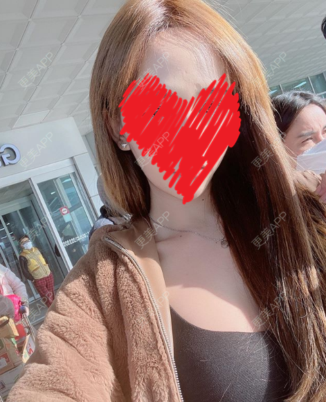 更美 - 更美用户XQLeLyMyaD的自体脂肪填充颈纹经验 | 自体脂肪填充颈纹