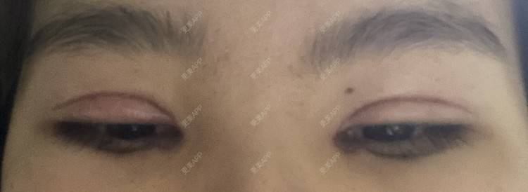 更美 - 更美用户LlGf9K7w9y的眼部多项经验 | 青岛 | 眼部多项